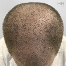 After Hair Transplant