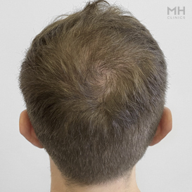 After Hair Transplant