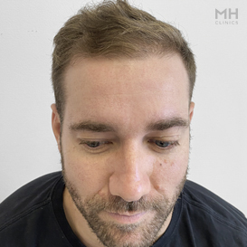 After Hair Transplant