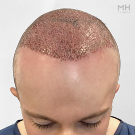 After Hair Transplant