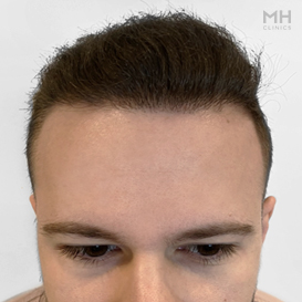 After Hair Transplant