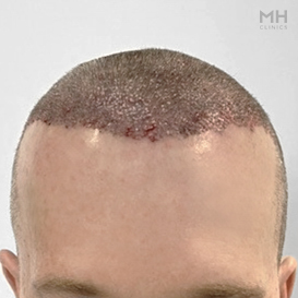 After Hair Transplant