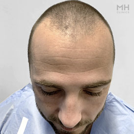 Before Hair Transplant