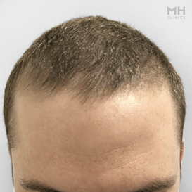 Before Hair Transplant