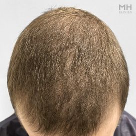 Before Hair Transplant