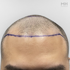 Before Hair Transplant