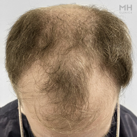 Before Hair Transplant