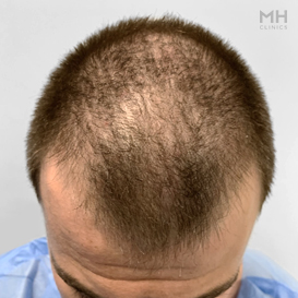 Before Hair Transplant