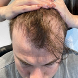 Before Hair Transplant