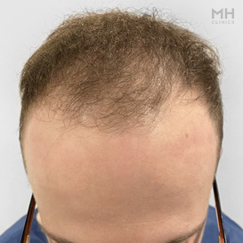 Before Hair Transplant