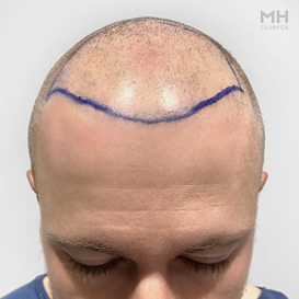 Before Hair Transplant