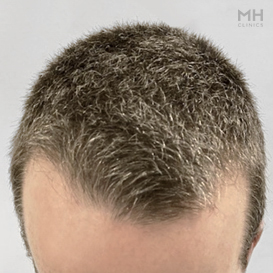 Before Hair Transplant