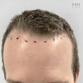 Before Hair Transplant