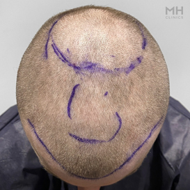 Before Hair Transplant