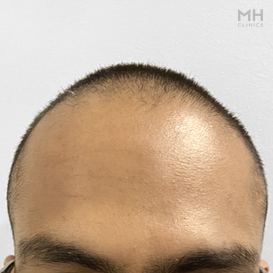 Before Hair Transplant