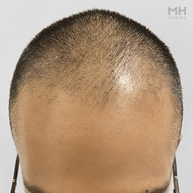 Before Hair Transplant