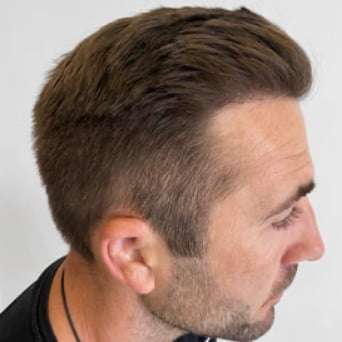 After Hair transplant