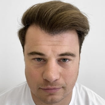 After Hair transplant