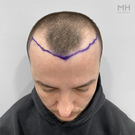 Before Hair Transplant