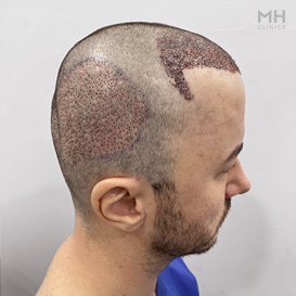 Before Hair Transplant