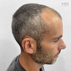 Before Hair Transplant