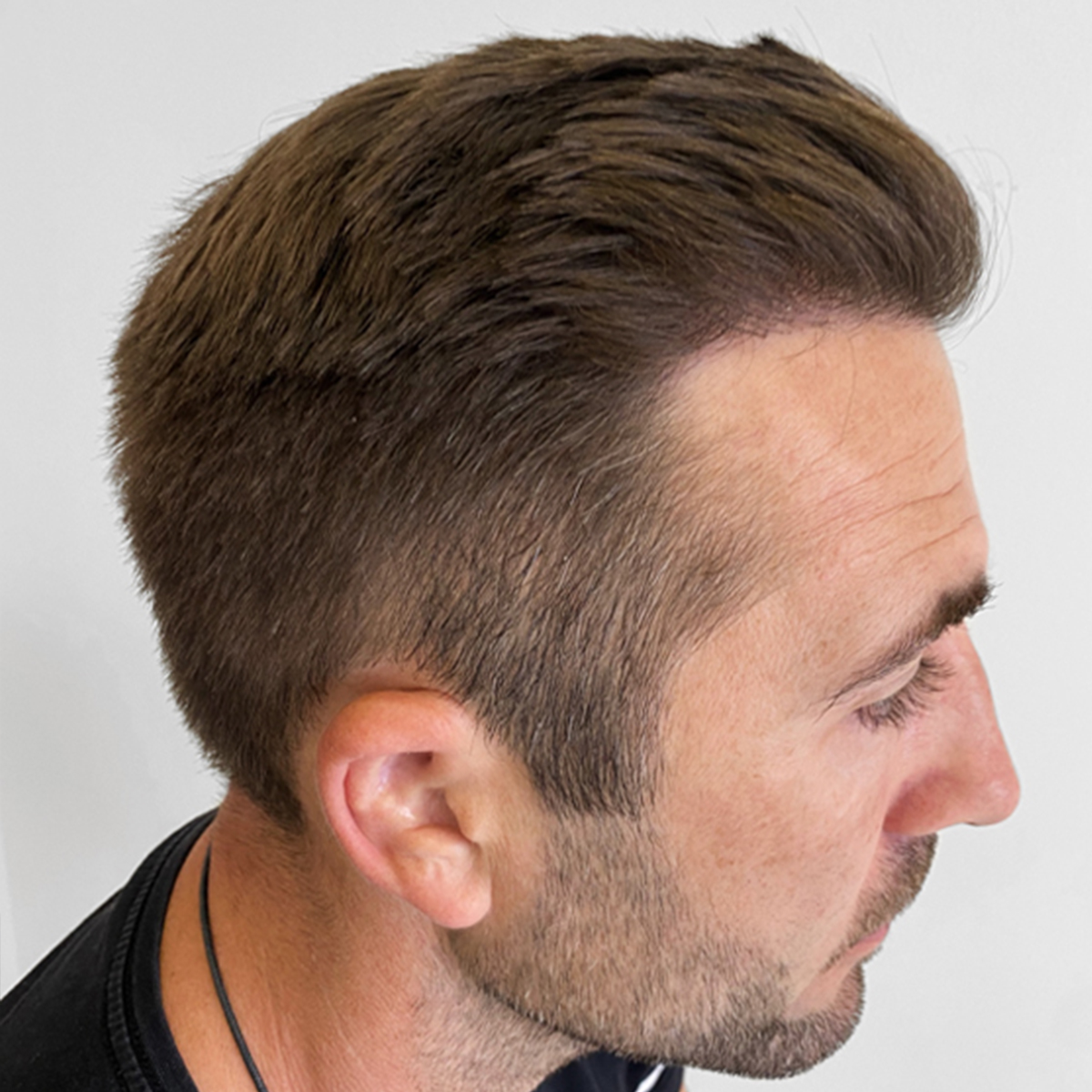 After Hair transplant