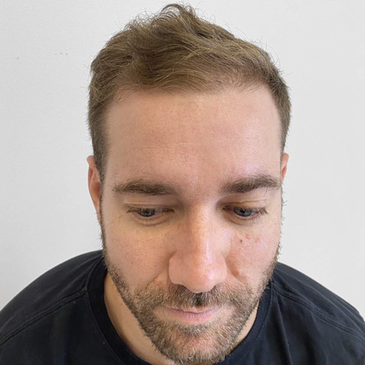 After Hair transplant