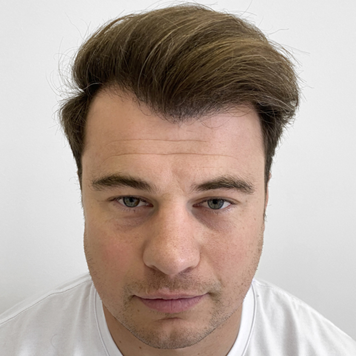 After Hair transplant