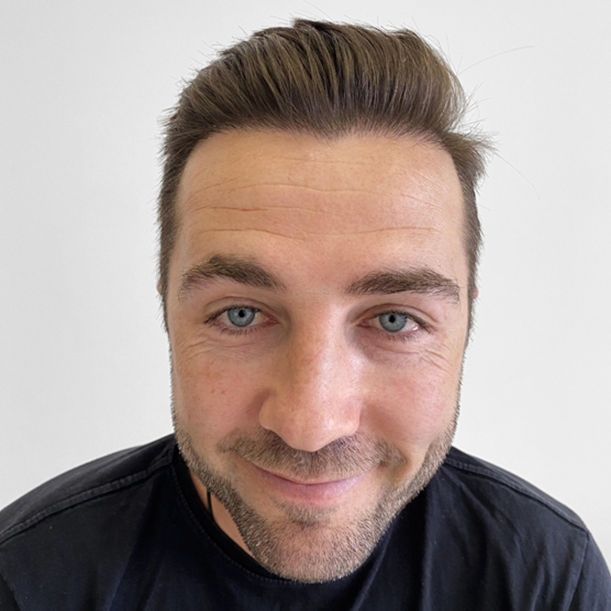 After Hair transplant