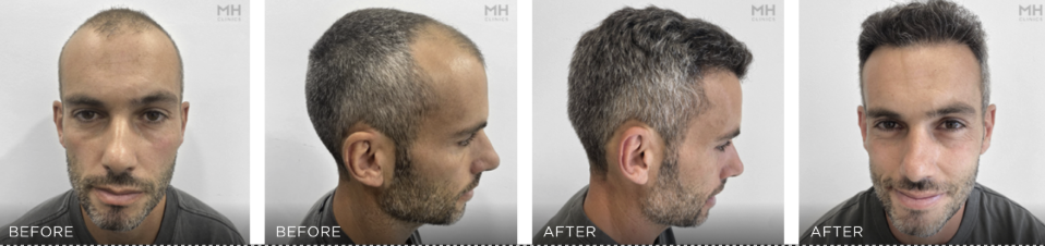 Hair Transplant Before and After Images