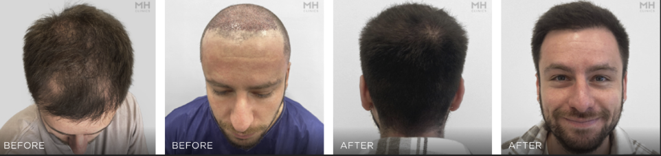 Hair Transplant Before and After Images