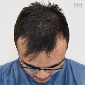 Before Hair transplant