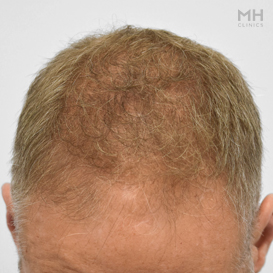 Before Hair transplant