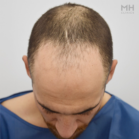 Before Hair transplant