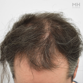 Before Hair transplant