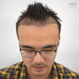 After Hair transplant