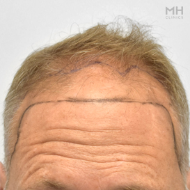Before Hair transplant