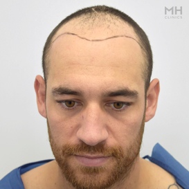 Before Hair transplant