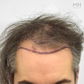 Before Hair transplant