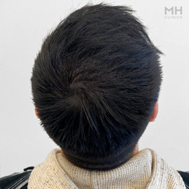 After Hair transplant