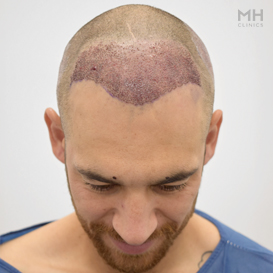 After Hair transplant