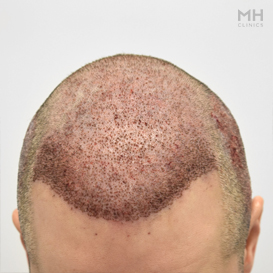 After Hair transplant