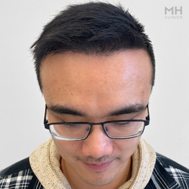 After Hair transplant