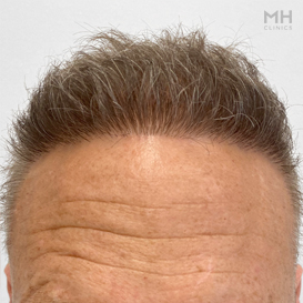 After Hair transplant