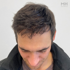After Hair transplant