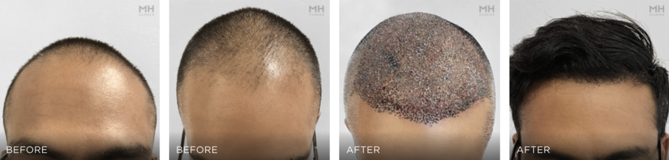 Hair Transplant before and after image