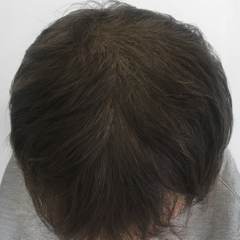 SMP Hair Transplant Before and After at Medihair