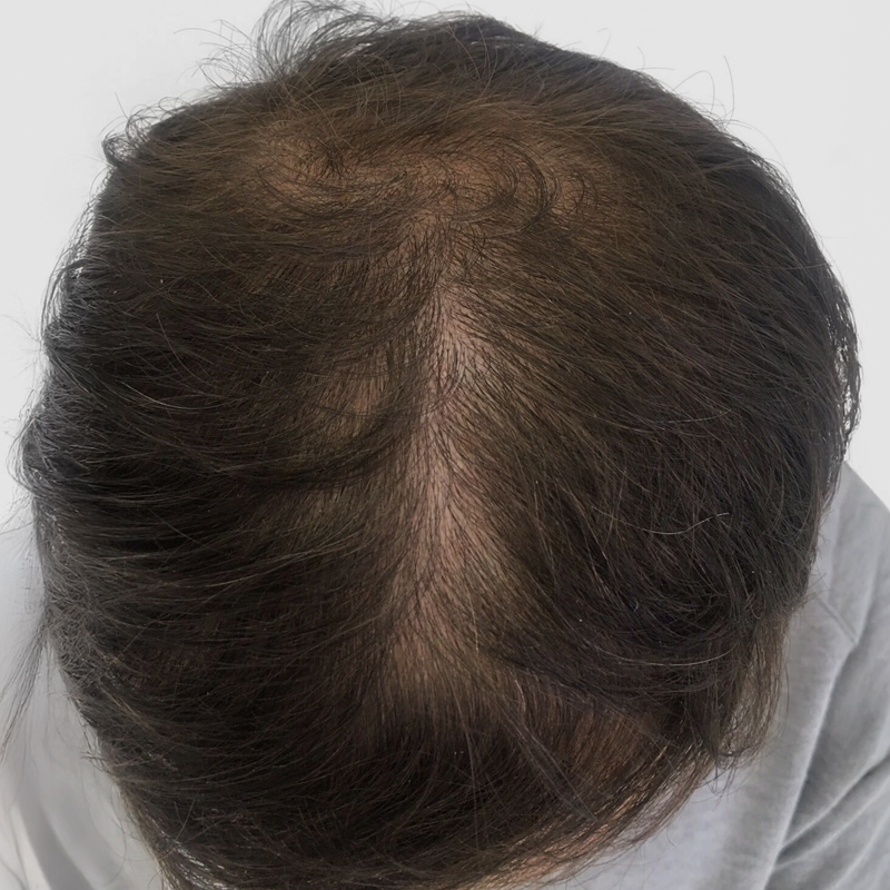 SMP Hair Transplant Before and After at Medihair
