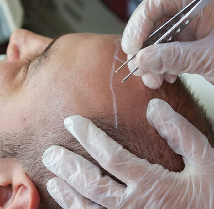 Designer Hair Transplants at Medihair in Melbourne
