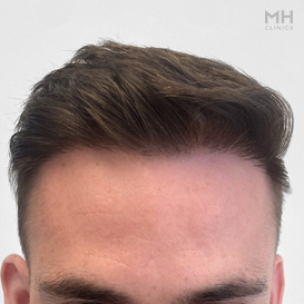 After Hair transplant